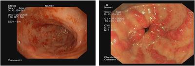 Recurrent gastric antral vascular ectasia: a single center experience